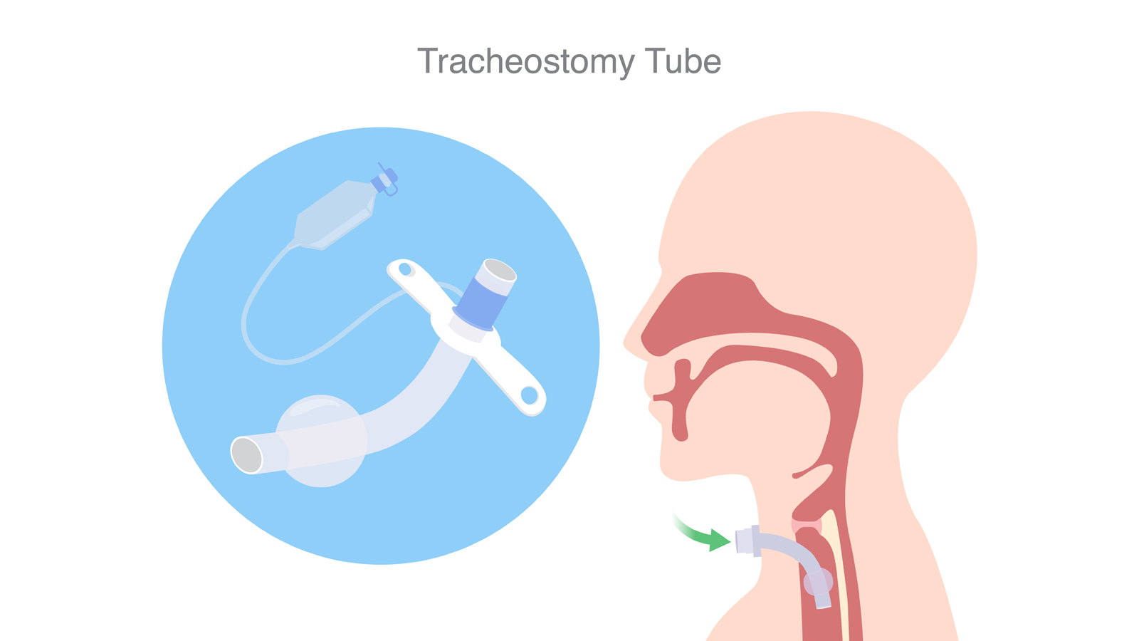 There is a shortage of tracheostomy tubes, including Bivona